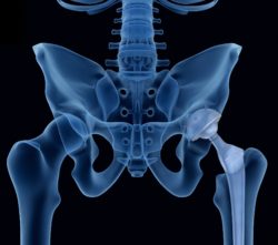 an Xray of a hip implant regarding the Wright defective hip implant settlement