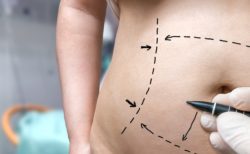 Stomach being prepped for surgery regarding the Dr. 6ix class action lawsuit filed